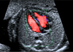 Pränatalmedizin Ultraschall Organbeurteilung - Herzkammern