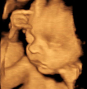 3D / 4D Ultraschall Baby - Sonographie