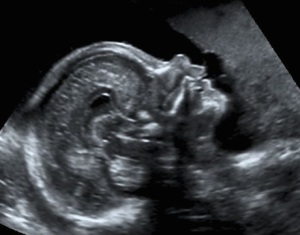 Detaillierter Organultraschall: Baby Profil - 22. Schwangerschaftswoche - Pränatalmedizin Meckenheim